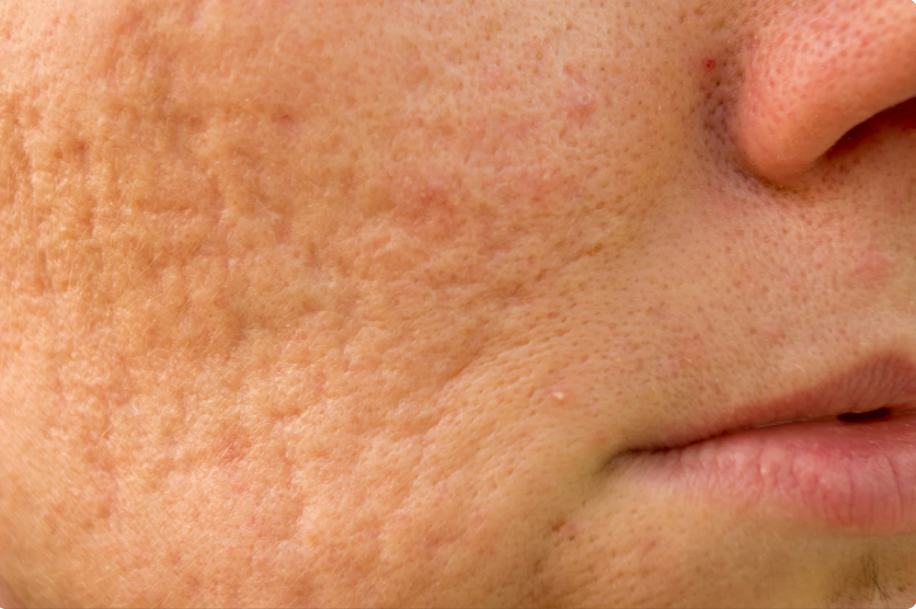 Microneedling for Men