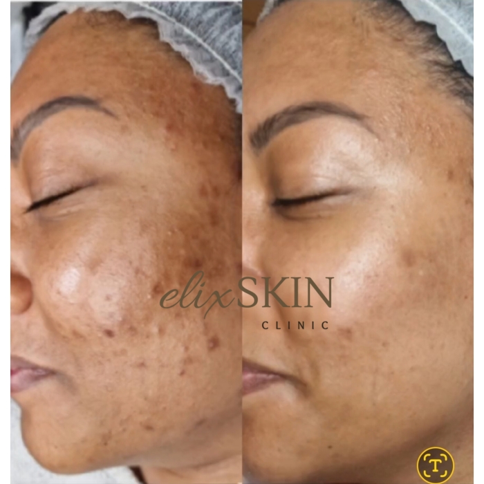 Hyperpigmentation
