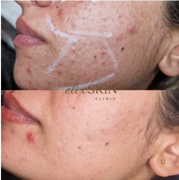 Acne Scarring