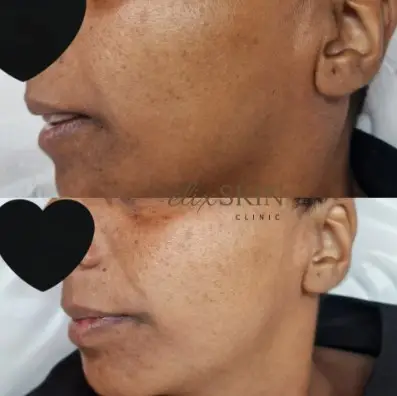 Melasma Treatment